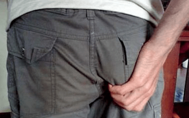 Itching as a sign of parasites in the anus