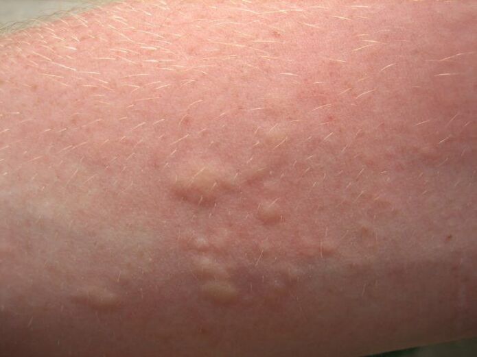 Itchy allergic skin rashes may be signs of ascariasis