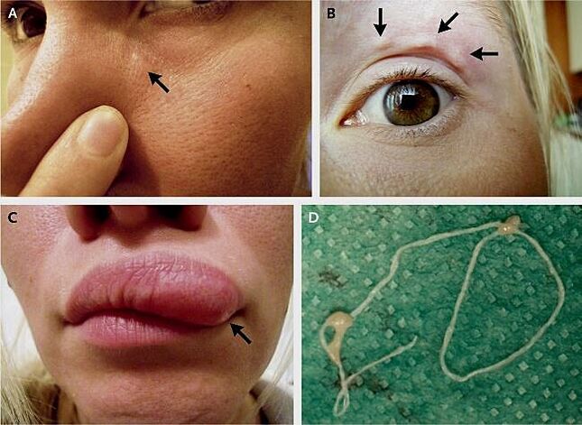 The main manifestations of facial dirophylariasis
