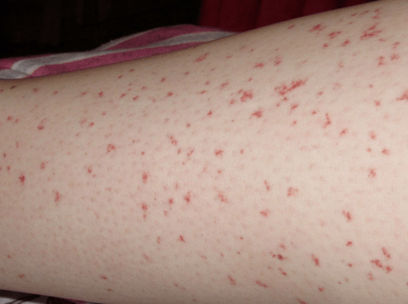 A skin rash is a sign of the acute phase of a worm infection